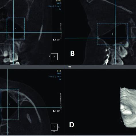 A Coronal B Sagittal And C Axial CBCT Images Showing Contour Of