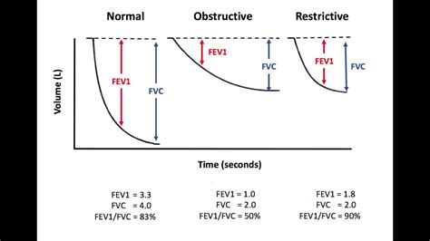 Obstructive Vs Restrictive Lung Disease Spirometry