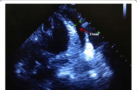 The Echocardiogram Showing Pericardial Effusion Red Arrow During Download Scientific Diagram