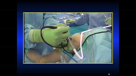 576 Knee Arthroscopy Set Up Youtube