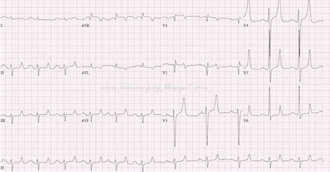 ECG Rhythms: Tented T waves of Hyperkalemia