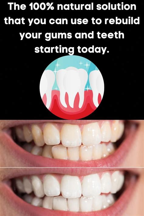 Get Rid Of Cavities And Tooth Decay Artofit