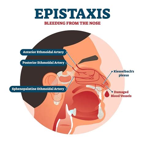 Understanding Epistaxis Causes Symptoms And Emergency Measures