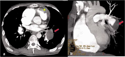 The Filling Defect Of Pulmonary Artery An Imaging Finding What We