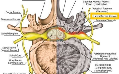 Whiplash: Definition, Causes, Symptoms, Diagnosis, and Treatment ...