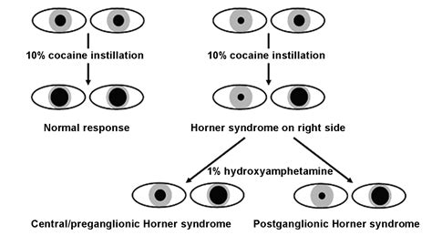 Horners Syndrome