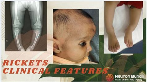 Clinical Features Of Rickets And X Ray Findings Cuppingfraying