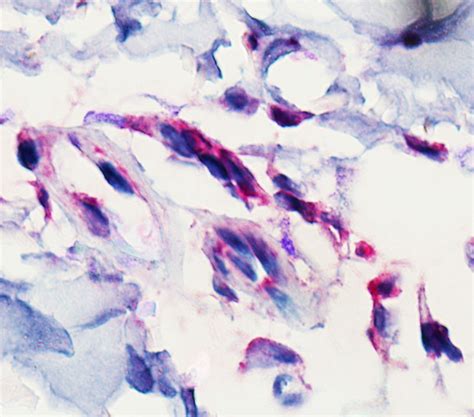 Cutaneous Immunoprofiles Of Three Spotted Fever Group Rickettsia Cases