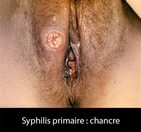 Syphilis Dr Kara Zaitri M A