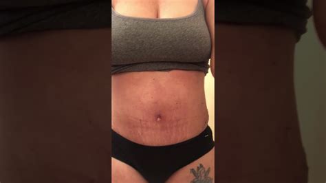 Tummy Tuck Day 19 Youtube