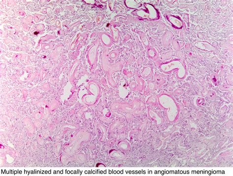 Pathology Outlines Meningioma