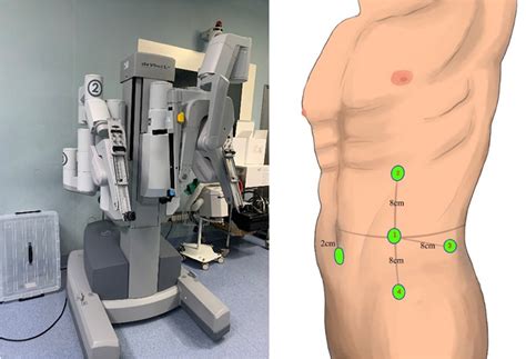 Retrospective Analysis Of Robot‐assisted Laparoscopic Transabdominal