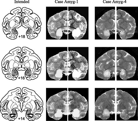 Comparison Of The Effects Of Bilateral Orbital Prefrontal Cortex