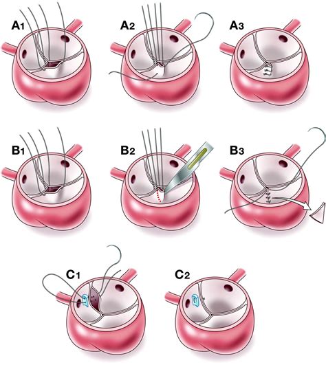 Aortic Valve Surgery In Children Heart