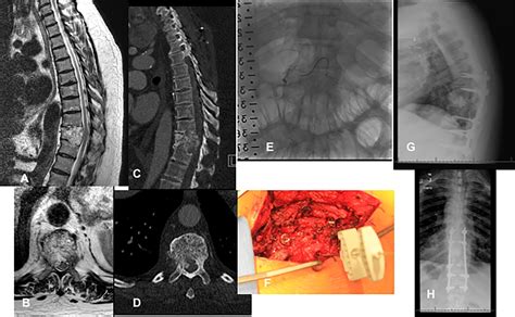 Surgical Management Of Aggressive Hemangiomas Of The Spine Journal Of