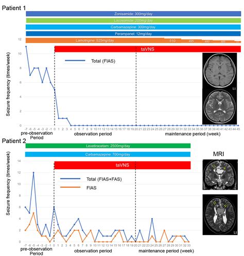 transcutaneous auricular vagus nerve stimulation therapy in patients ...