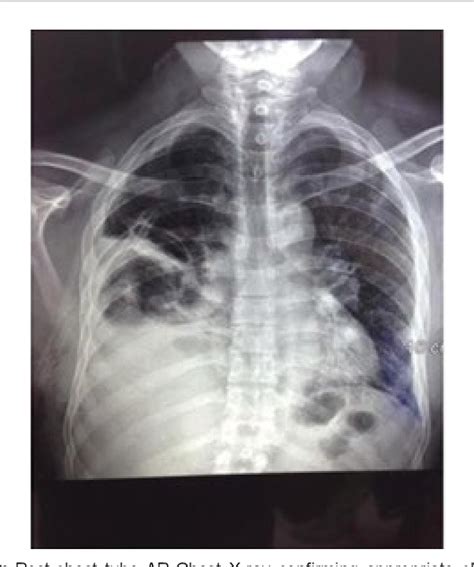 Figure From Malignant Tension Hydrothorax With Mediastinal Shifting