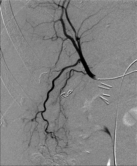 Angiogram Following Coil Embolization Of Right Hepatic Artery