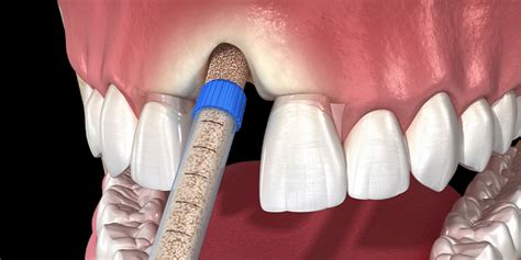 Prf Grafting In Implant Dentistry Dr Jaclyn Wong Melbourne