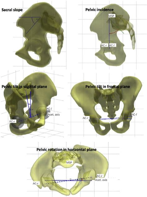 Pelvic Parameters Including Sacral Slope Ss Pelvic Incidence Pi