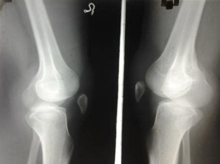 Nail Patella Syndrome Radiology Reference Article Radiopaedia Org