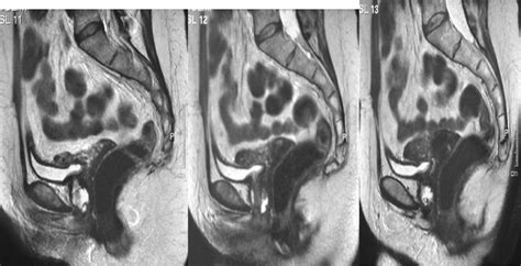 Management Of Symptomatic Urethral Diverticula In Women A Single