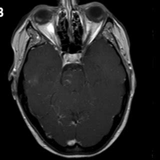 A Axial Post Contrast T Weighted Magnetic Resonance Image Mri