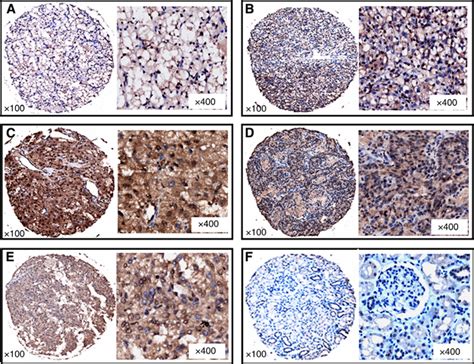 Immunohistochemical Staining Of Golph3 In Rcc Specimens And Normal