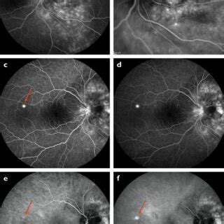 A D Fluorescein Angiography Showed Early Spotty And Late Diffuse