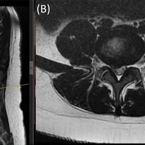 T2 Weighted Sagittal A And Axial B Mri Demonstrating Disc