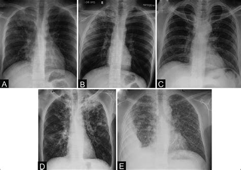 A E Chest Radiographs In Active Tb A Cxr Depicts Rt Upper Zone Download Scientific