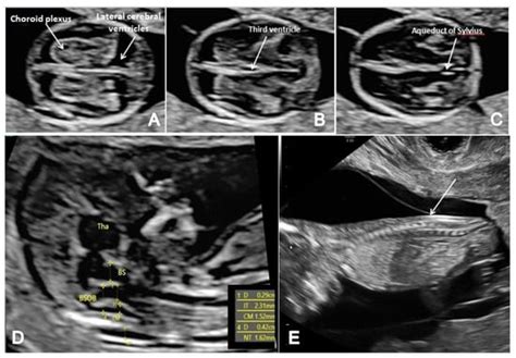 Brain Sciences Free Full Text First Trimester Ultrasound Detection