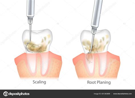 Difference Periodontal Scaling Root Planing Oral Hygiene Conventional Periodontal Therapy Stock