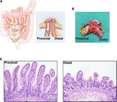 Frontiers The Pathology And Physiology Of Ileostomy