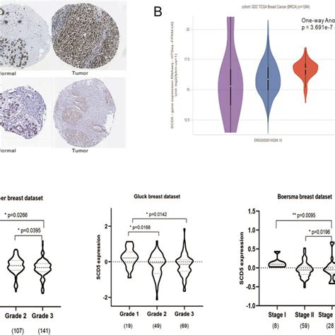 Scd Expression In Breast Cancer A Representative Result Of Scd And