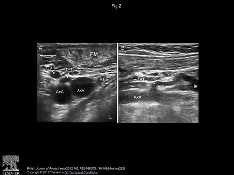 Ultrasound Guided Infraclavicular Axillary Vein Cannulation A Useful