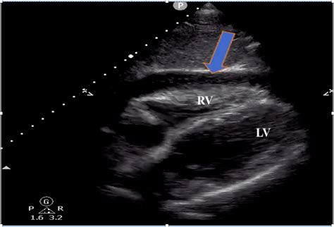 Hemopericardium And Cardiac Tamponade After Blunt Thoracic Trauma A