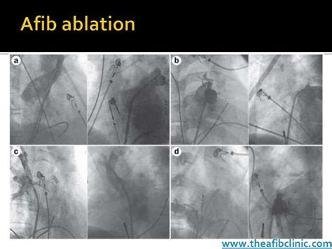 Afib Ablation Safe And Effective Ablation Using Low Fluoroscopy G…