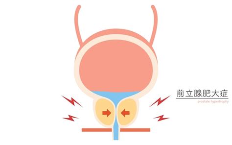 Illustration M Dicale De L Hyperplasie B Nigne De La Prostate Normale