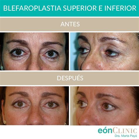 Blefaroplastia Cirugía de párpados Eon Clinic Mallorca