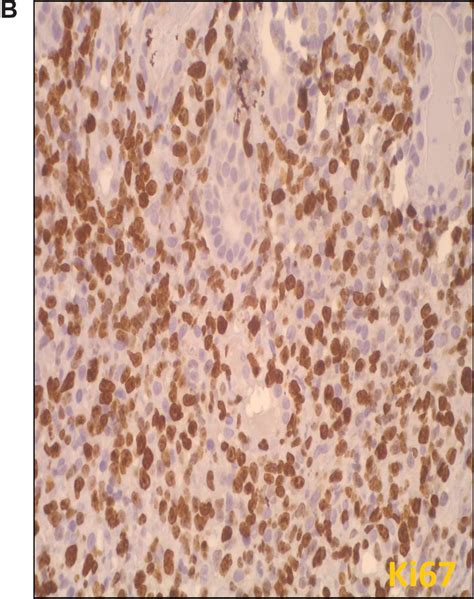 Diffuse Proliferation Of Small Atypical Lymphoid Cells Partly Effacing