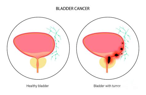 Bladder Cancer Stages Photograph By Pikovit Science Photo Library