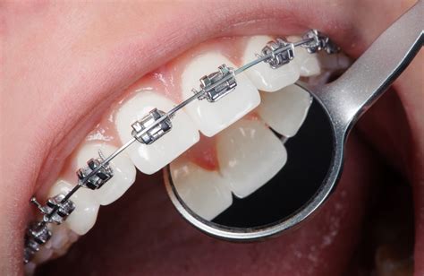 Orthodontie Choisir Entre Les Bagues Dentaires Ou Les Aligneurs