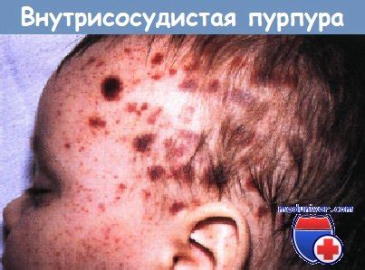 Внесосудистая и внутрисосудистая пурпуры у ребенка