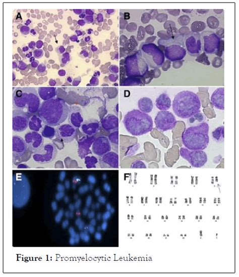 The Structure Of Acute Promyelocytic Leukemia