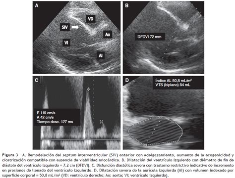 Ecocardiografía en infarto agudo del miocardio