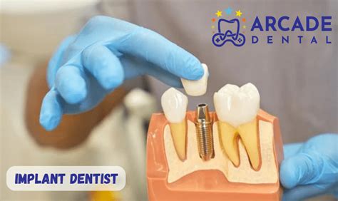 Tips to Find the Best Implant Dentist Near You