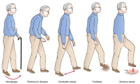 How To Cure And What To Avoid In Parkinsons Disease