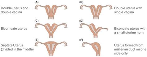 Mullerian Duct Anomalies — Classification And Development