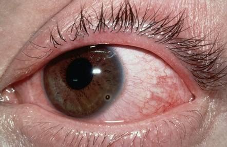 Corneal Injuries - RCEMLearning